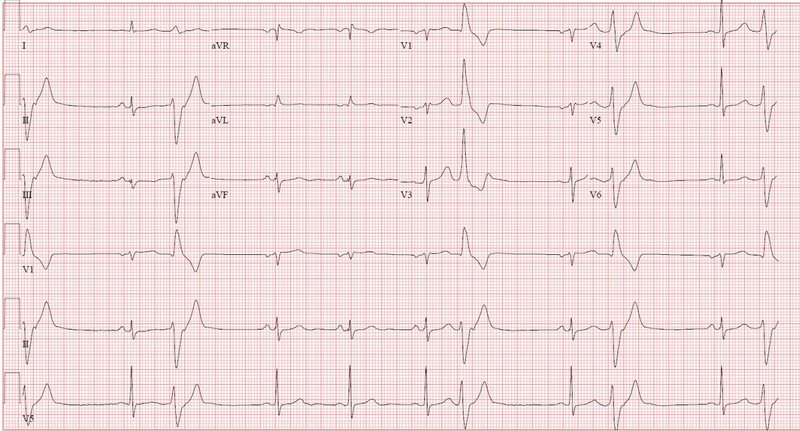 An electrocardiogram depicting multiple premature ventricular contractions. (Via Zach Goldberger)