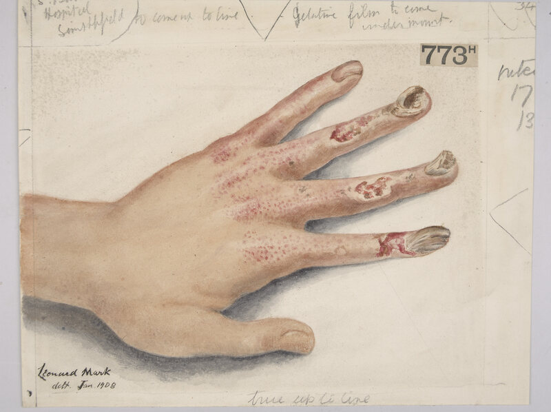 A 1908 watercolor of a patient's chronic dermatitis, a result of overexposure to X-rays.