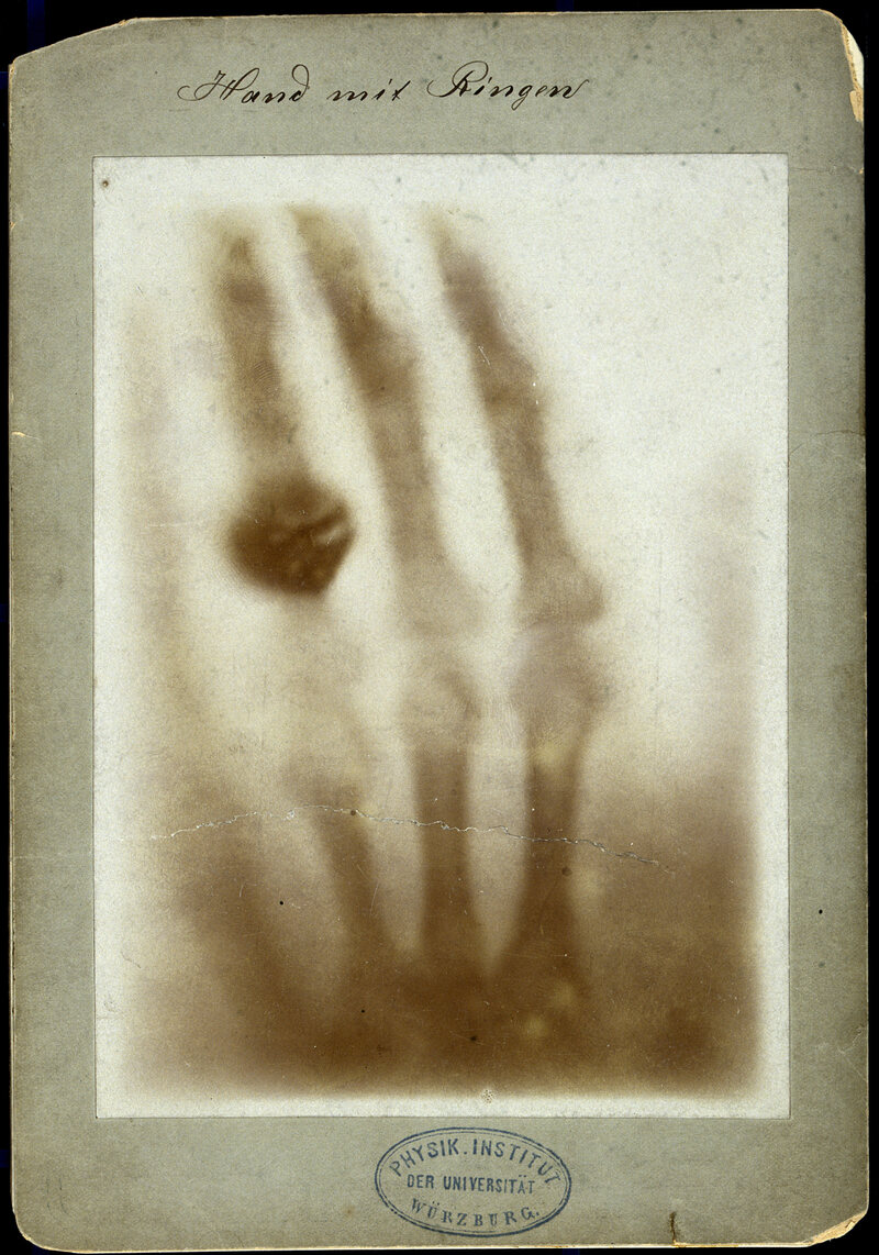 The first X-ray image, "Hand mit Ringen" by Wilhelm Conrad Roentgen, 1895.