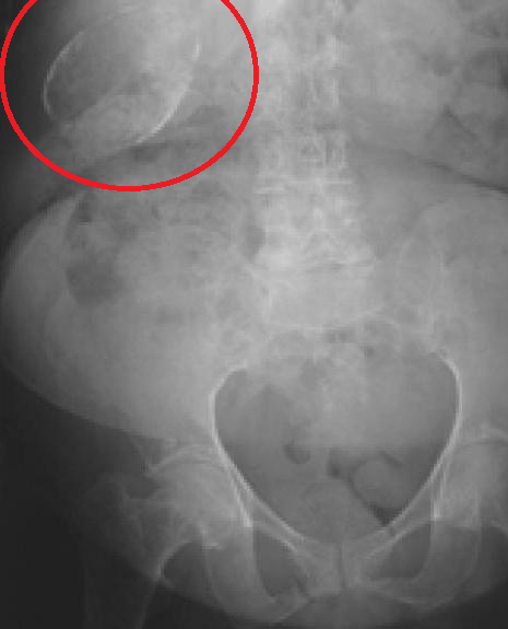 An X-ray of a different porcelain gallbladder from 2010 shows where they normally sit within the body.