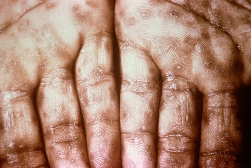 Syphilis lesions can look similar to smallpox lesions, an unfortunate coincidence that had horrible consequences. 