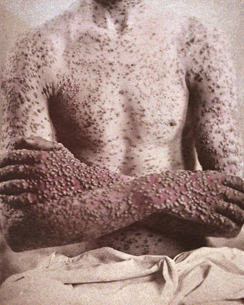 Before being eradicated, smallpox terrorized the world for thousands of years.