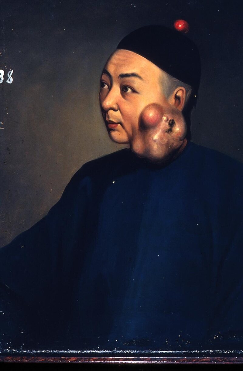 Portrait 38, showing a man with an ulcerous tumor on his left cheek.