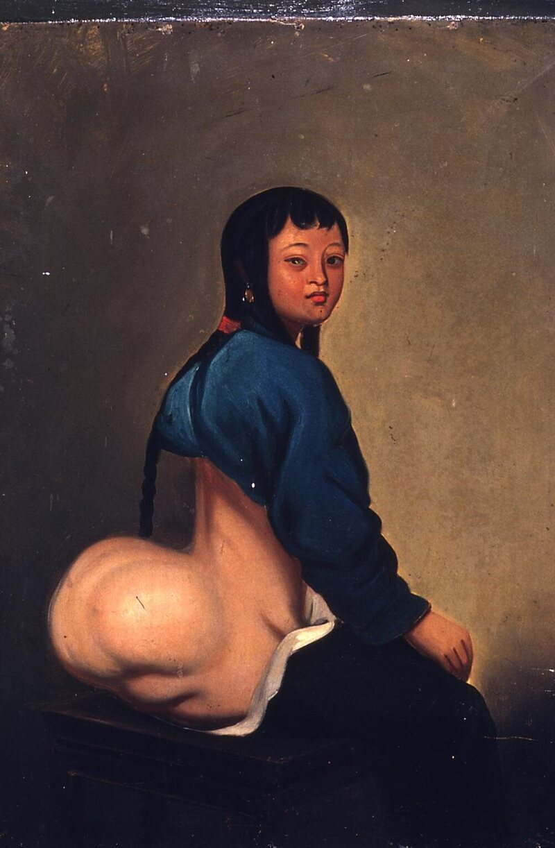 Lam Qua's portrait of Lew Akin, a 12-year-old patient with a steatomatous tumor on her right hip.