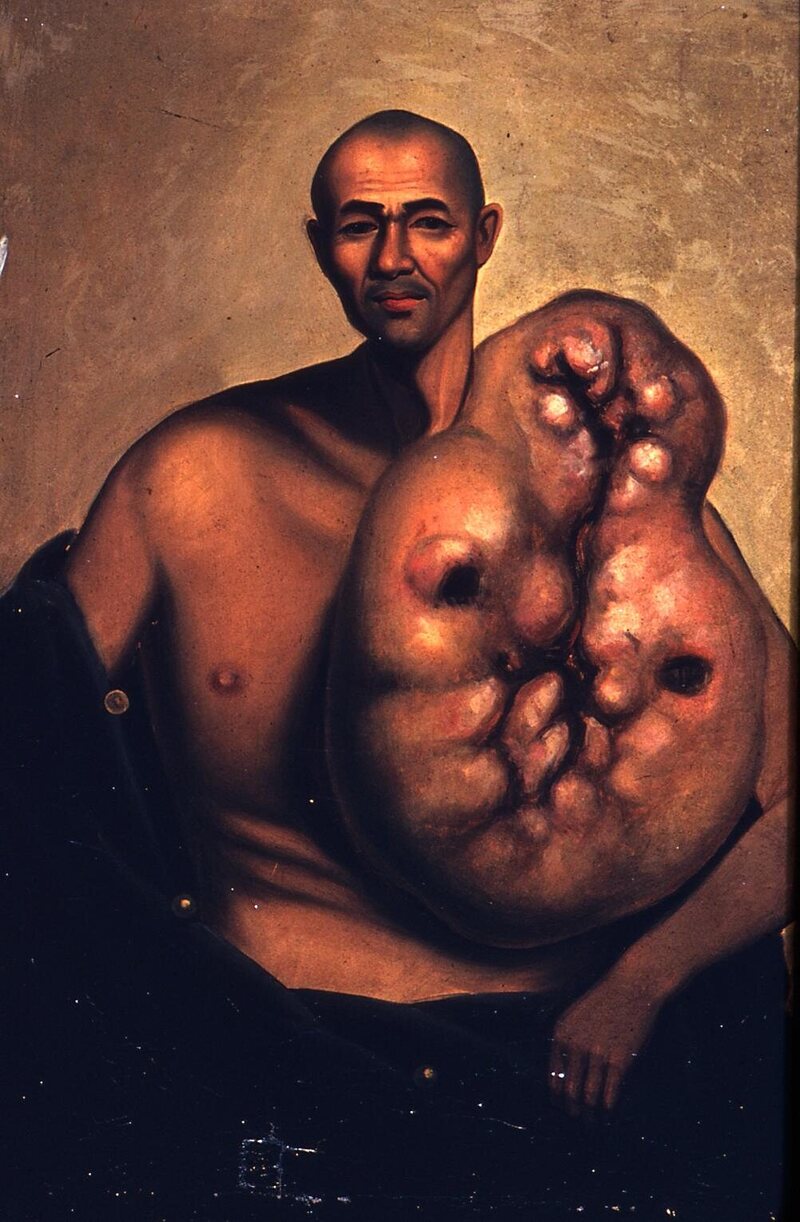 Lam Qua's portrait of Woo Kinshing, a man with a massive tumor of the left chest wall.