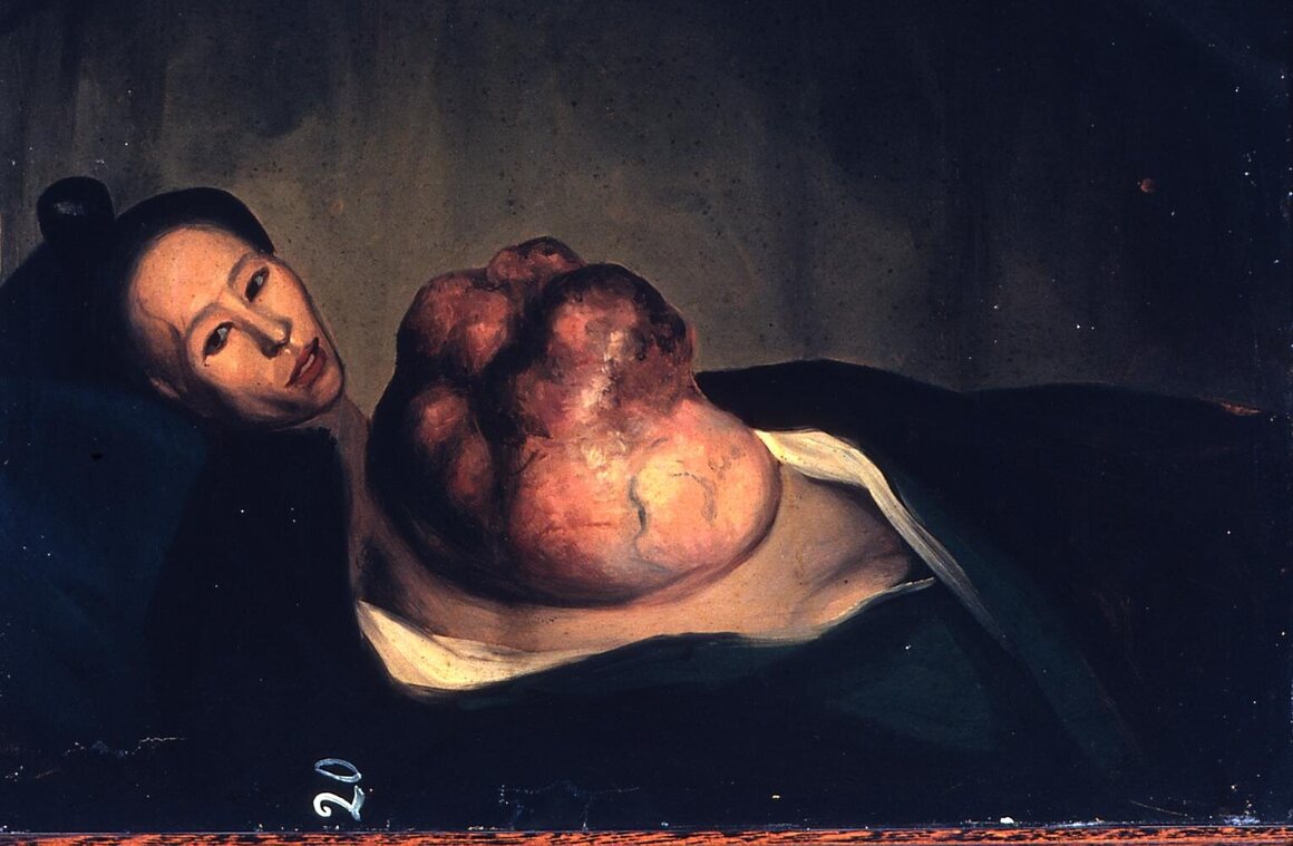 Lam Qua's portrait of a woman with a malignant tumor on her chest wall.
